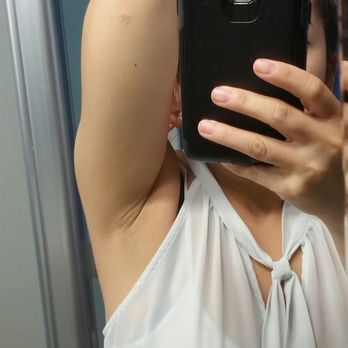 Athenix - Ugly scar from surgery done 5 years ago - Medical Spas Near Me - Irvine, California Athenix - Ugly scar from surgery done 5 years ago - Medical Spas Near Me - Irvine, California