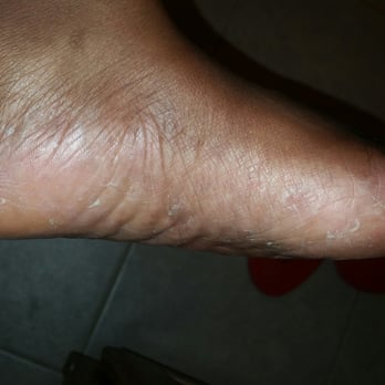 Image Nails - Pedi tech used the callus remover tool on my feet then left broken, peeling skin all over my feet! - Nail Salons Near Me - Missouri City, Texas Image Nails - Pedi tech used the callus remover tool on my feet then left broken, peeling skin all over my feet! - Nail Salons Near Me - Missouri City, Texas
