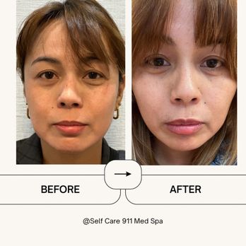 Self Care 911 Med Spa - You want a natural subtle look ? Power of Cheek Fillers: It defined her face & added a contour .model requested Natural look lip filler - Weight Loss Centers Near Me - Mountain View, California Self Care 911 Med Spa - You want a natural subtle look ? Power of Cheek Fillers: It defined her face & added a contour .model requested Natural look lip filler - Weight Loss Centers Near Me - Mountain View, California