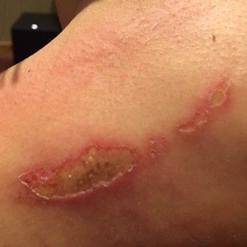 David Dong - I received a first and second degree burn from David Dong. Worst part is that he denied causing this damage. Very dishonest person! - Naturopathic/Holistic Near Me - Oakland, California David Dong - I received a first and second degree burn from David Dong. Worst part is that he denied causing this damage. Very dishonest person! - Naturopathic/Holistic Near Me - Oakland, California