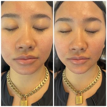 Be You Medical - Before and after! Jawline and chin enhanced. - Medical Spas Near Me - Sacramento, California Be You Medical - Before and after! Jawline and chin enhanced. - Medical Spas Near Me - Sacramento, California