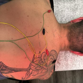 The Pine Chiropractic & Acupuncture - Electric stimulation is what's to be expected And a post cooling cream to aid relaxation. - Chiropractors Near Me - San Diego, California The Pine Chiropractic & Acupuncture - Electric stimulation is what's to be expected And a post cooling cream to aid relaxation. - Chiropractors Near Me - San Diego, California