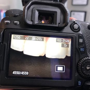 Bella Smiles - Chipped front before bonding - Cosmetic Dentists Near Me - Las Vegas, Nevada Bella Smiles - Chipped front before bonding - Cosmetic Dentists Near Me - Las Vegas, Nevada