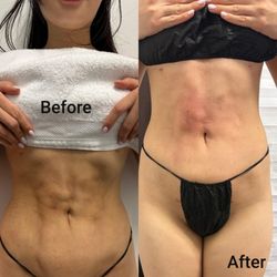 Massage Saranity & Body Sculpting - Fibrosis from lipo, broken down with continued sessions