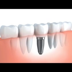 Aloha Dental - $1999 Dental Implant including Abutment and Crown.