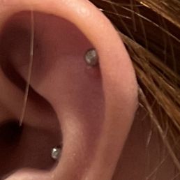 Infected ear piercing done by unprofessional piercer Infected ear piercing done by unprofessional piercer