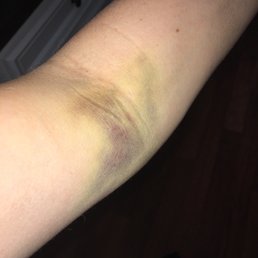 My blown vein, 2nd IV attempt. She finally got it the 3rd time. I'm 32 with great veins. My blown vein, 2nd IV attempt. She finally got it the 3rd time. I'm 32 with great veins.