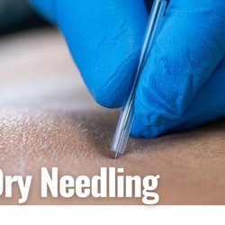Stephens Chiropractic - Dry needling uses thin sterile needles to target muscle trigger points, helping reduce muscle tension, relieve pain, and improve movement.