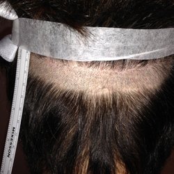 Hidden shave FUE technique so the entire donor area doesn't need to be shaved.