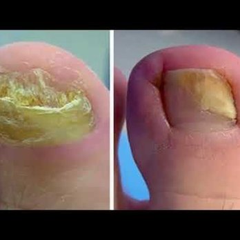 Pedi Care - Podiatrists Near Me - Puerto Vallarta, JAL