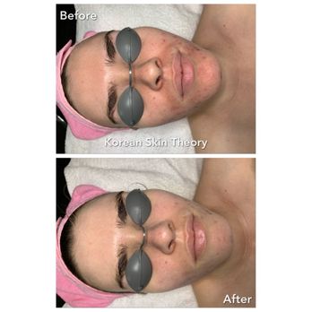 Korean Skin Theory - One treatment - Skin Care Near Me - San Jose, California Korean Skin Theory - One treatment - Skin Care Near Me - San Jose, California