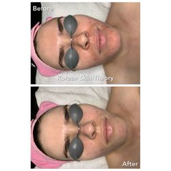 Korean Skin Theory - One treatment