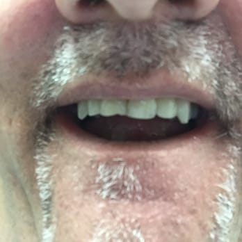 Dental Depot - CHIPPED TOOTH BEFORE....... - General Dentistry Near Me - Oklahoma City, Oklahoma Dental Depot - CHIPPED TOOTH BEFORE....... - General Dentistry Near Me - Oklahoma City, Oklahoma