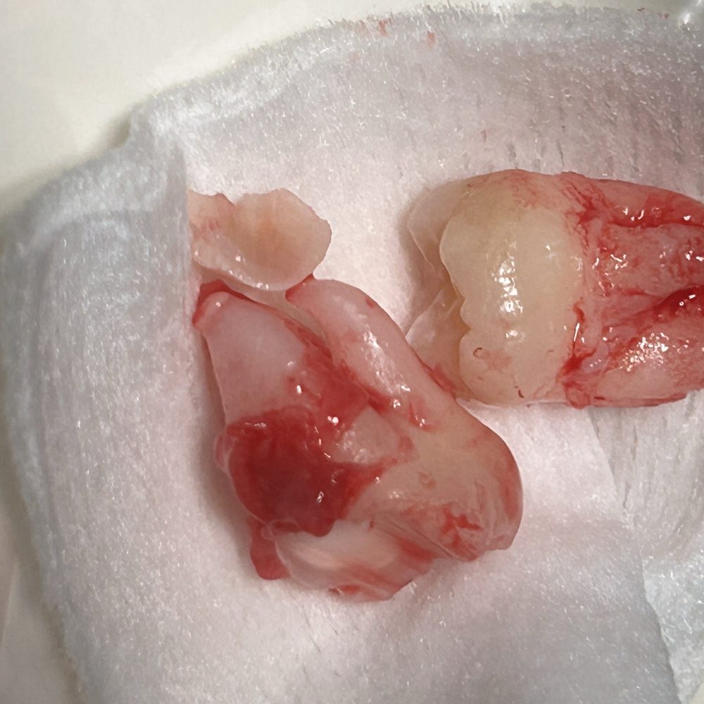 Wisdom teeth