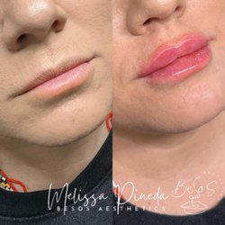 Besos Aesthetics - Lip Filler