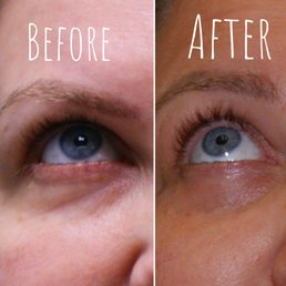 After three sessions of Erbium laser After three sessions of Erbium laser