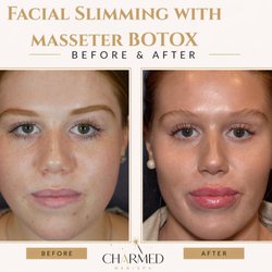 Charmed Medispa - Masseter Botox for Facial Slimming at Charmed Medispa