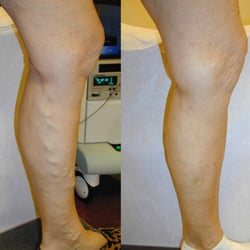Carolina Vein Institute
