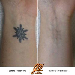 Removery Tattoo Removal & Fading