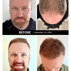 Flintridge Fue Hair Clinic & Wellness - 3,300 grafts. 12-months results.