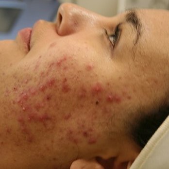 AlecXander Medical Spa - Acne is one of our specialties. With proper topical products and treatments, we can help you fight any acne on any skin type. - Skin Care Near Me - Hurst, Texas AlecXander Medical Spa - Acne is one of our specialties. With proper topical products and treatments, we can help you fight any acne on any skin type. - Skin Care Near Me - Hurst, Texas