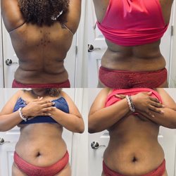Flawless Beauty Bar - 360 lipo after one session