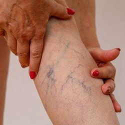 Arizona Vein & Laser Institute of Scottsdale - Get rid of those unsightly veins today!