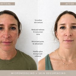 Botox Kailua - Mircroneedling + Skin Resurfacing