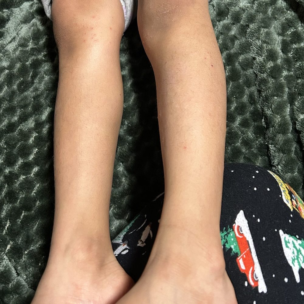 Coco Nail Lounge - The weird rash my daughter broke out in from the pedicure - Nail Salons Near Me - Riverton, Utah Coco Nail Lounge - The weird rash my daughter broke out in from the pedicure - Nail Salons Near Me - Riverton, Utah