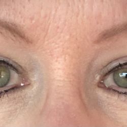 Springs Aesthetics - After but not fully healed.