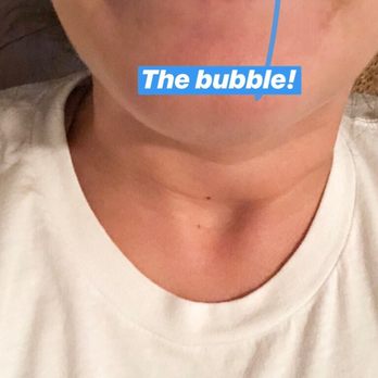 Laser Sculpture - Today: Stretching my lip a little so you can see it! Months after filler, I still have a little bubble! Hoping it goes away on its own! - Medical Spas Near Me - Torrance, California Laser Sculpture - Today: Stretching my lip a little so you can see it! Months after filler, I still have a little bubble! Hoping it goes away on its own! - Medical Spas Near Me - Torrance, California