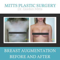 Gordon M Mitts, MD - Breast Implant Bakersfield, CA