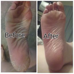I had tried everything & my foot skin was still wrecked. After pedicure, I was able to file it down more at home to get it perfect. 8/18/16