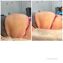 BabyCakez - Laser Liposuction