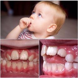 Park Avenue Cosmetic Dentistry and Implant Center - Thumb sucking habits can lead to open bite and other dental problems