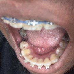 Bright Now Dental & Orthodontics - No tooth.
