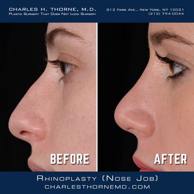 Rhinoplasty (Nose Job) Before & After Plastic Surgery - What are you looking for in your rhinoplasty? Everyone is different and every nose is different, but there are a few things that MOST people have in common. Most patients want to look more elegant or more handsome, but they don't want people to say, "Hey, you had a nose job." They want the nose to fit the face so that other people are attracted to the whole face, not the surgery! The other thing almost all female patients say is, "I don't want a tiny, turned up nose."