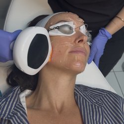 Blue Medi Spa - IPL Laser in Sherman Oaks