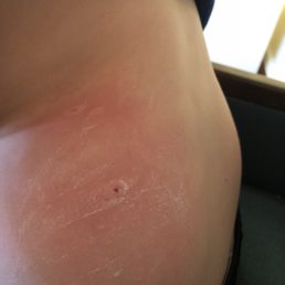 Bee sting