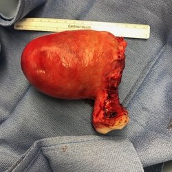 Violi Caterina Obgyn - Fibroid