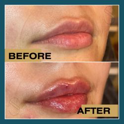 Spindrift Aesthetics - Before and After Lip Filler at Spindrift Aesthetics