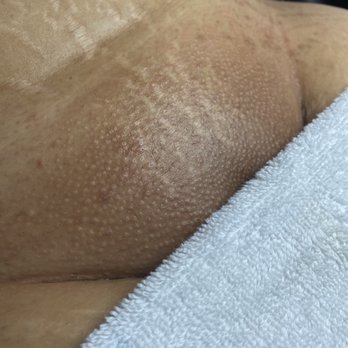 MBS Esthetics - Results after a vajacial - Skin Care Near Me MBS Esthetics - Results after a vajacial - Skin Care Near Me