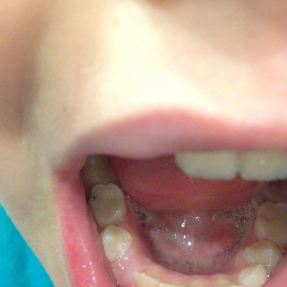 Heaney Stephen M DDS - After - Oral Surgeons Near Me - Orland Park, Illinois