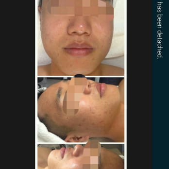 Joyce Beauty Studio - These are after treatment photos of me. - Skin Care Near Me - San Diego, California Joyce Beauty Studio - These are after treatment photos of me. - Skin Care Near Me - San Diego, California
