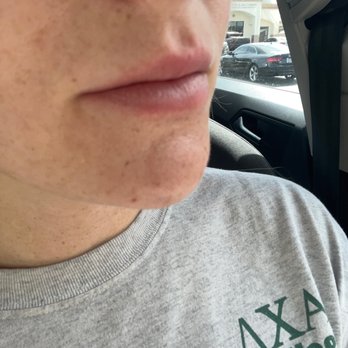 Face Forward Aesthetics - Today no filler in over 6 months - Medical Spas Near Me - Henderson, Nevada