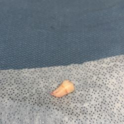 Nathan Ching, DDS - Park Saratoga Dental - Wisdom tooth