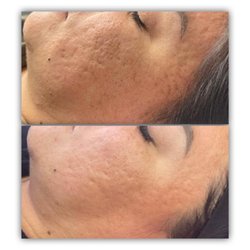 The Touch - Microneedling Before and After 3 sessions