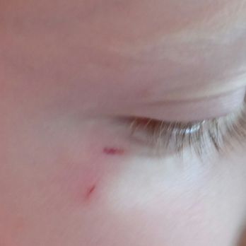 Joso's Play and Learn Centre - What an un-trimmed and sharp zip tie did to my daughter's eye at this place. They clearly do not care about safety! - Child Care & Day Care Near Me - Calgary, Alberta Joso's Play and Learn Centre - What an un-trimmed and sharp zip tie did to my daughter's eye at this place. They clearly do not care about safety! - Child Care & Day Care Near Me - Calgary, Alberta