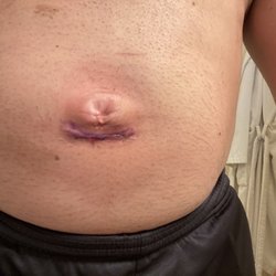 Sherry A Burchell, MD - Bellybutton