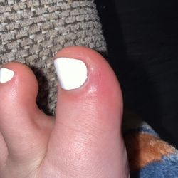 Hollywood Nails & Spa - Cellulitis